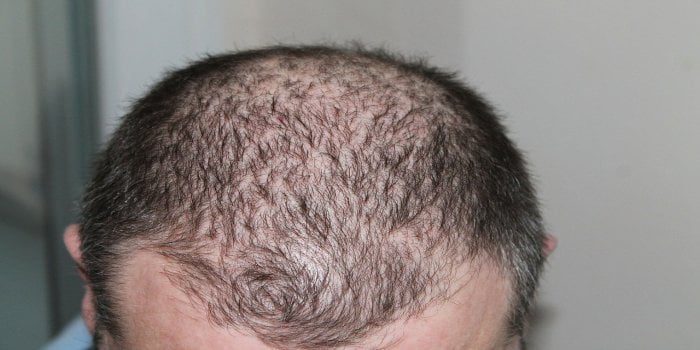 how to reverse hair loss